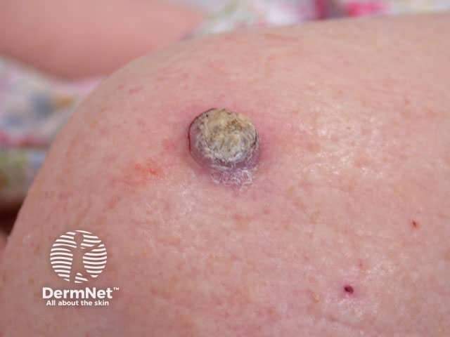 Rak kolczystokomórkowy – guzek z hiperkeratozą