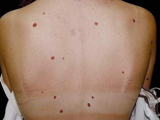 Zespół znamion dysplastycznych Zespół znamion dysplastycznych