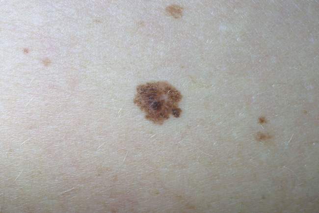 Wczesny czerniak - bezobjawowy mimo niepokojących cech wizualnych Wczesny czerniak bezobjawowy