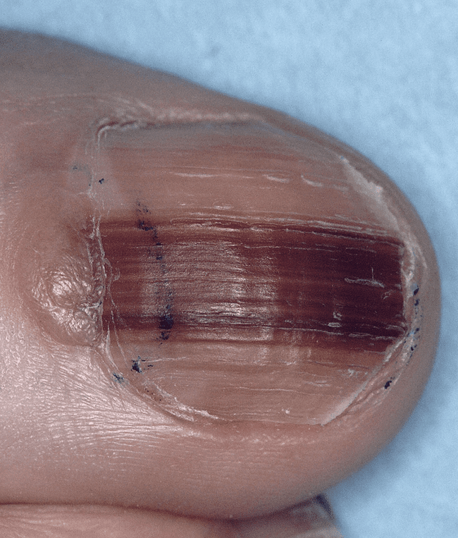 Czerniak złośliwy (melanoma malignum)