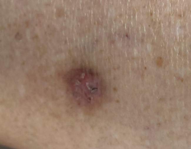 Rak podstawnokomórkowy