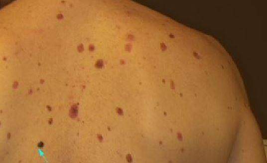 Czerniak u pacjenta z zespołem znamion dysplastycznych. Czerniak u pacjenta z zespołem znamion dysplastycznych.