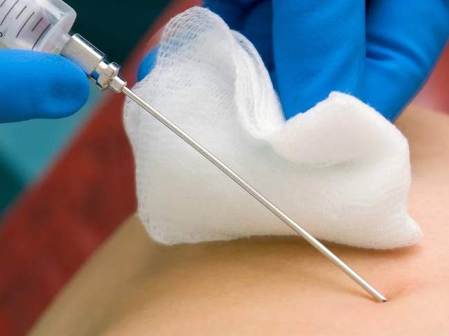 Strzykawka i igła używa do biopsji cienkoigłowej.  Strzykawka i igła używa do biopsji cienkoigłowej.