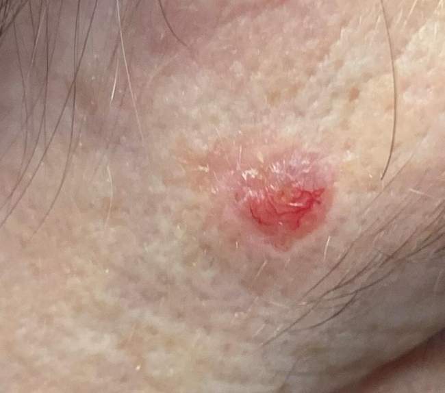 Rak podstawnokomórkowy — zdjęcie kliniczne