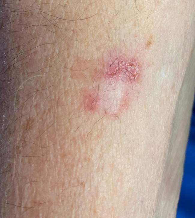 Rak podstawnokomórkowy — zdjęcie kliniczne