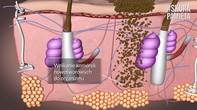 Komórki nowotworowe wnikają w głąb organizmu, przedostając się do naczyń krwionośnych i limfatycznych Komórki nowotworowe wnikają w głąb organizmu, przedostając się do naczyń krwionośnych i limfatycznych