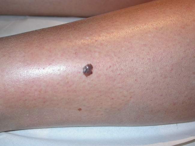 Czerniak skóry - melanoma zdjęcie medyczne nowotwór barwnikowy