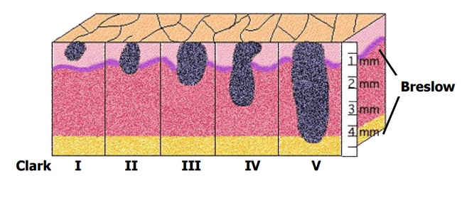 Grubość nacieku według Breslowa Grubość nacieku według Breslowa