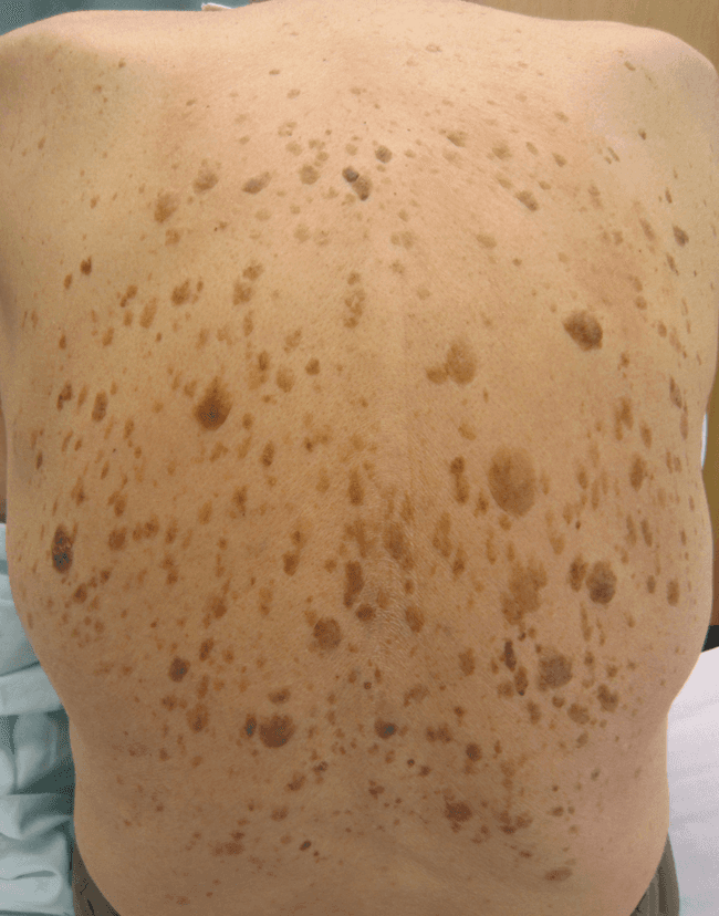 Brodawka łojotokowa - keratosis seborrhoica