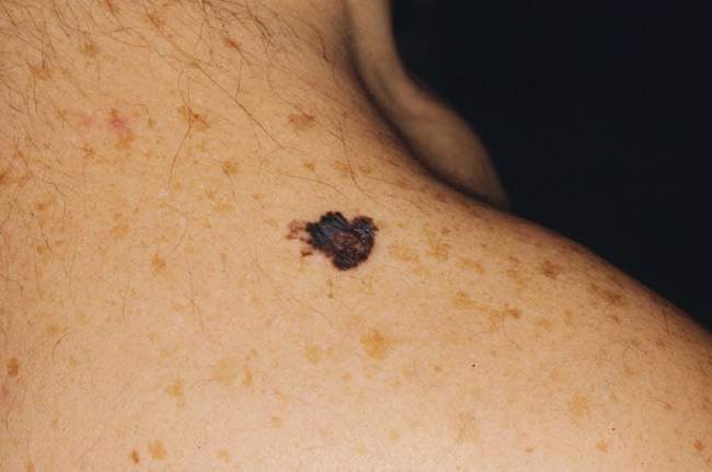 Czerniak skóry - melanoma nawrót w bliźnie po wycięciu