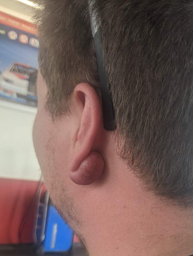 Bliznowiec (keloid) płatka ucha