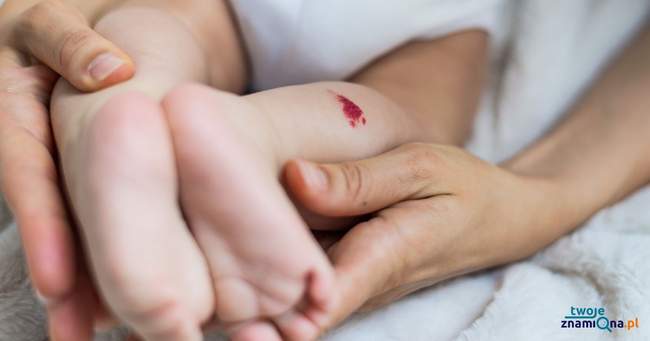 Naczyniak na nodze dziecka