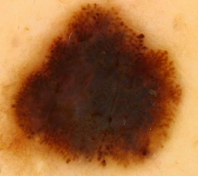 Czerniak u pacjenta z zespołem znamion dysplastycznych. Czerniak u pacjenta z zespołem znamion dysplastycznych.
