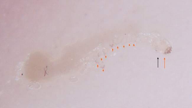 Obraz świerzbu w badaniu dermatoskopowym Obraz świerzbu w badaniu dermatoskopowym