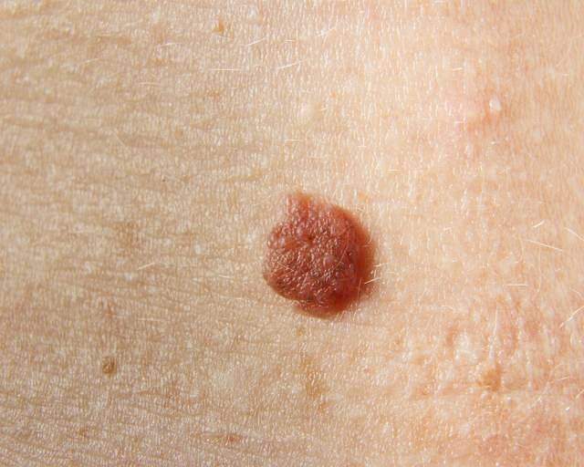 włókniak włókniak