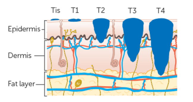 Czerniak TNM Czerniak TNM