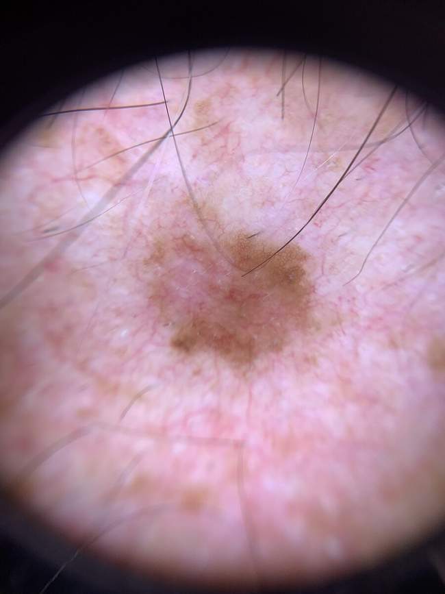 Rak podstawnokomórkowy — obraz dermatoskopowy