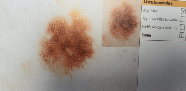 Znamię - ocena na podstawie 3-punktowej skali dermatoskopowej.  Znamię - ocena na podstawie 3-punktowej skali dermatoskopowej. (Dermatoskopia - H.P. Soyer; G. Argenziano; R. Hofmann-Wallenhof; I. Zalaudek)